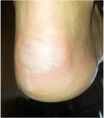 Monsterblase im Entstehen